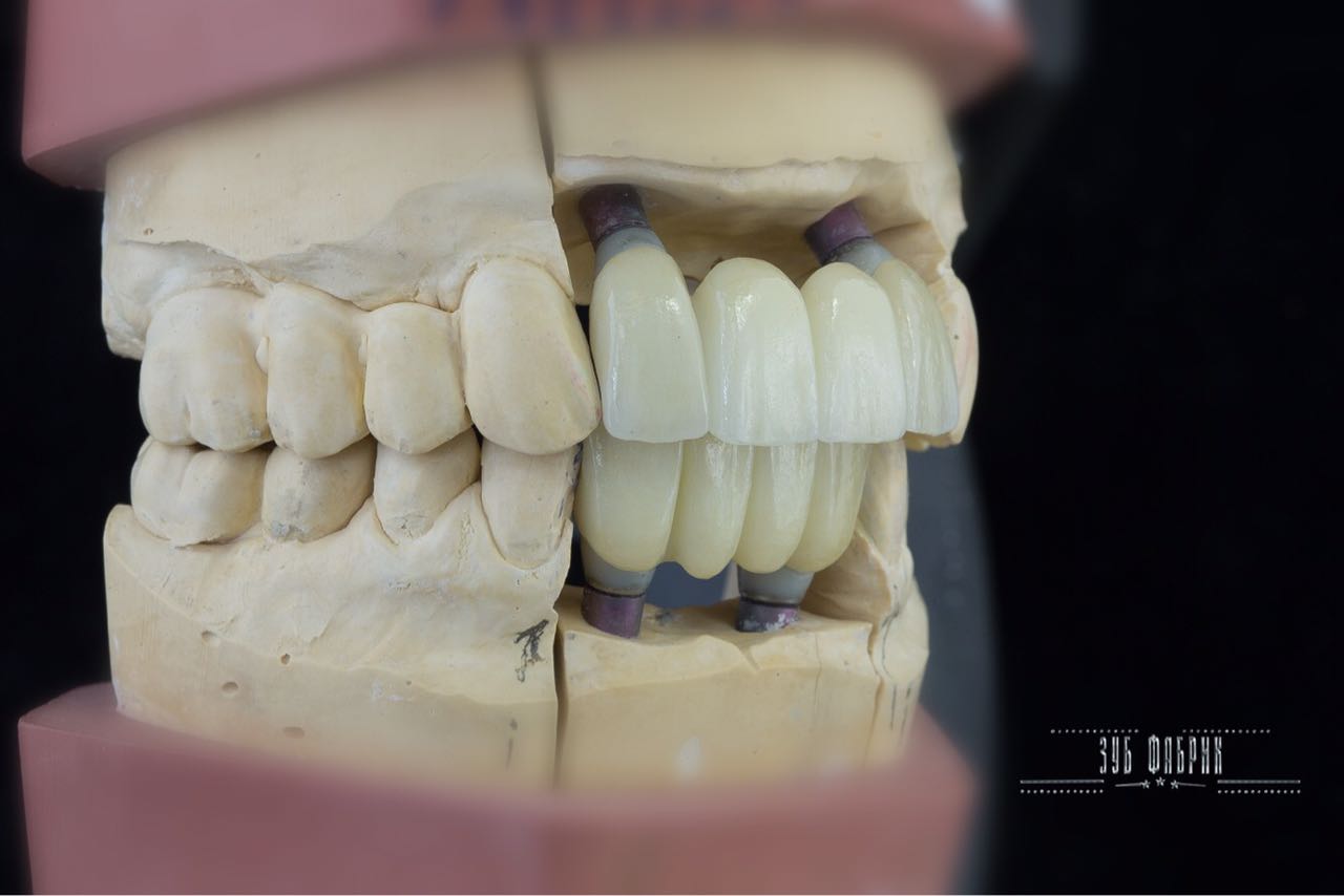 Несъемные зубные протезы All on 4 несъемные зубные протезы